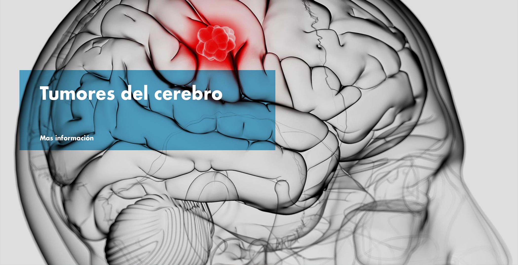 Tumores en el cerebro